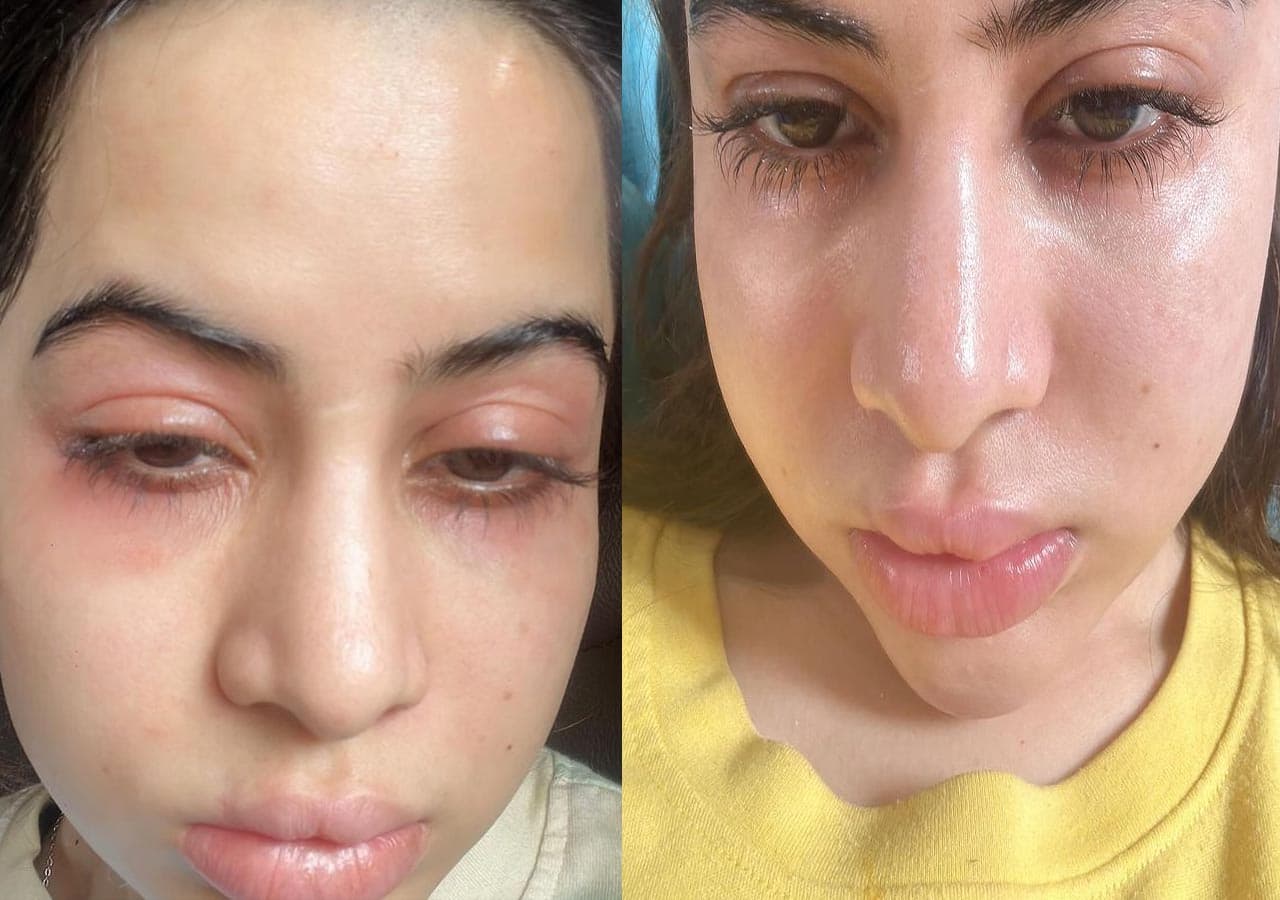 Urfi Javed shares shocking pictures of her face; insists it’s not fillers but THIS